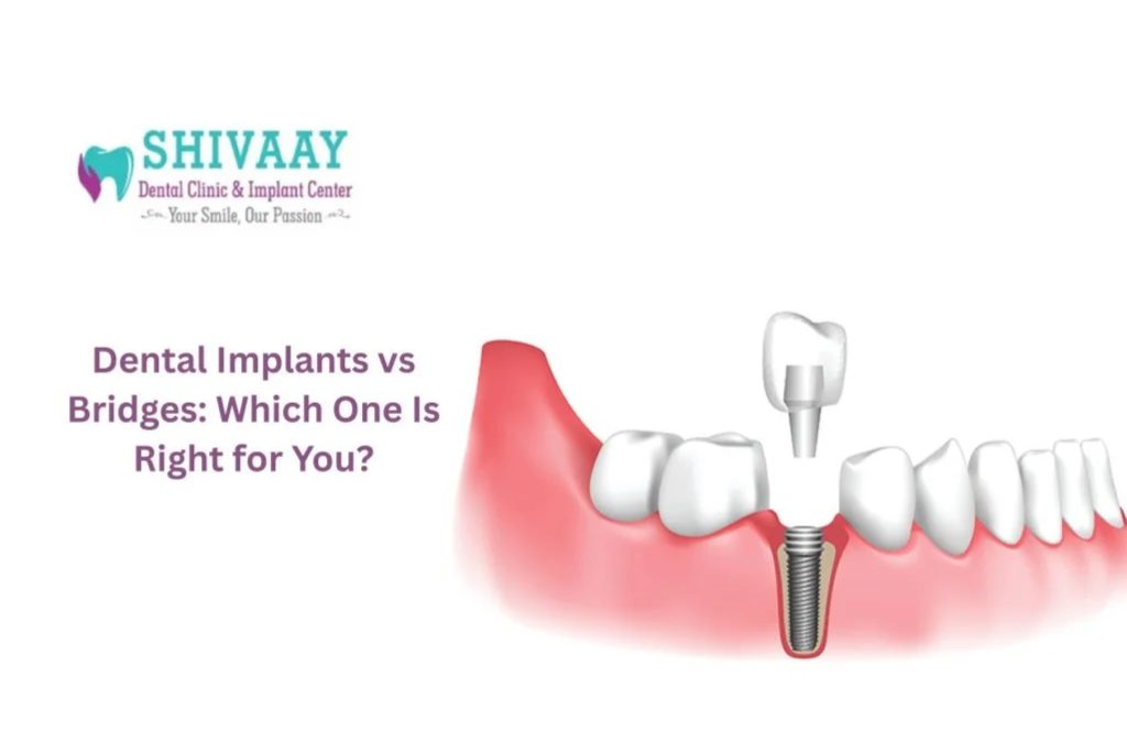 Dental Implants vs Bridges: Which One Is Right for You?