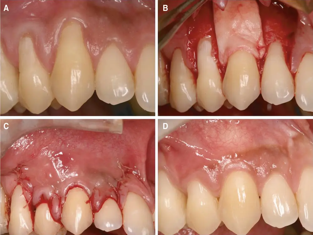 Periodontal Plastic Surgery 1