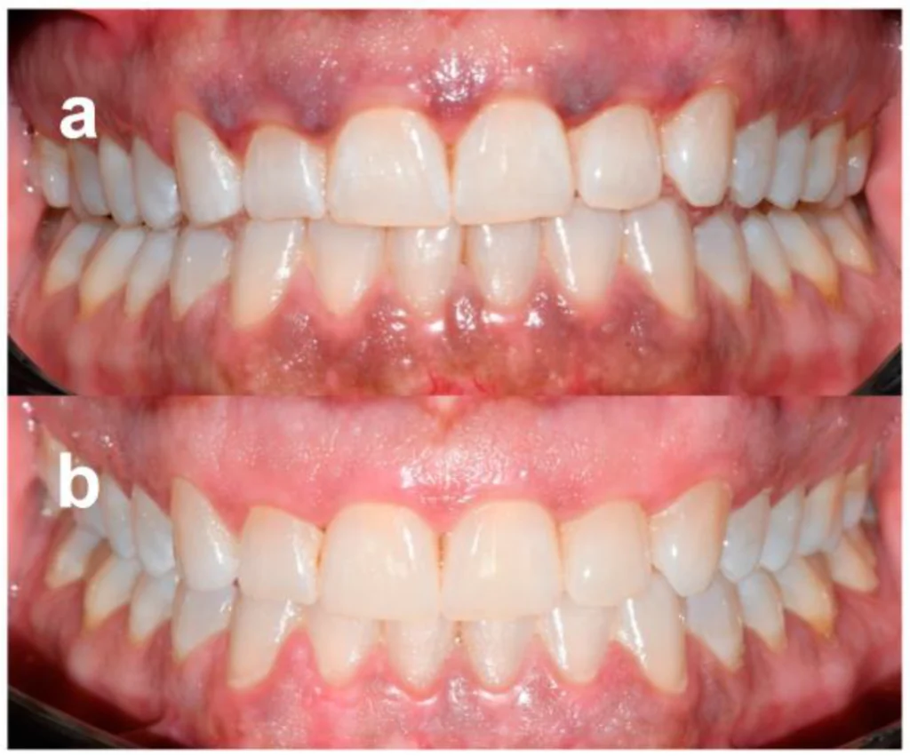 Before and after images showcasing teeth with Gingival Depigmentation, done by Dr. Rashmi Rathore's at Shivaay Dental Clinic.