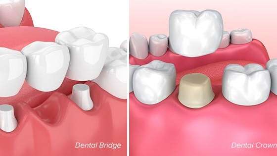 Dental Crowns vs. Bridges: Which Option Is Right for You?