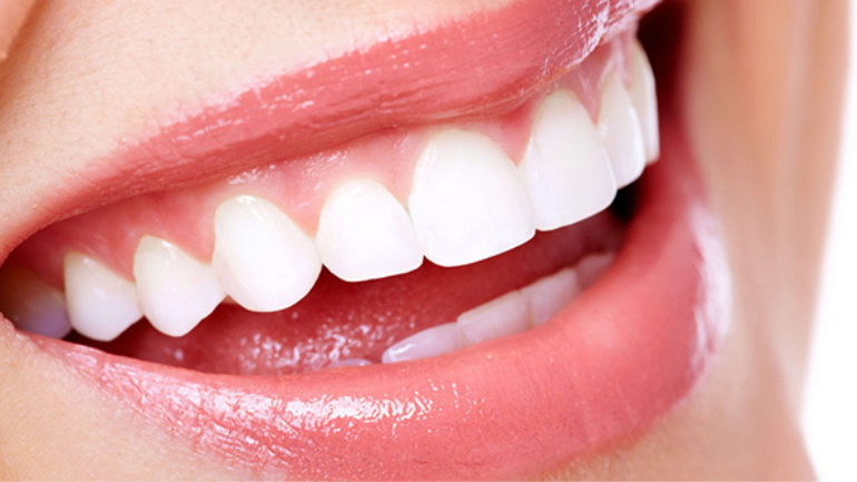 Bridal Smile Makeovers: What to Plan Before the Big Day