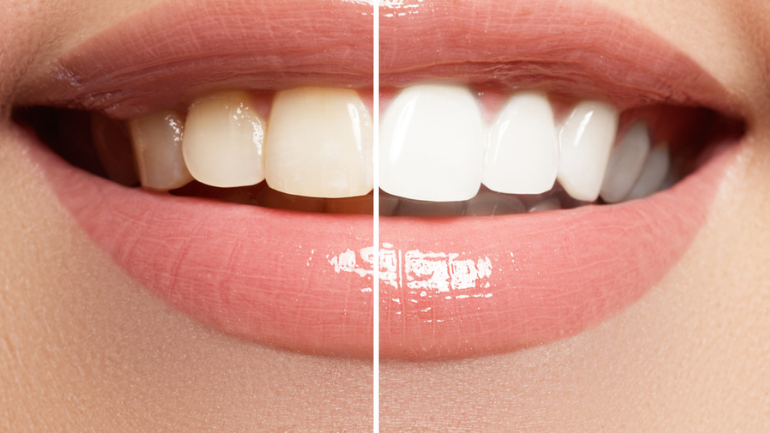 Laser Whitening: Brighten Teeth With Minimal Sensitivity