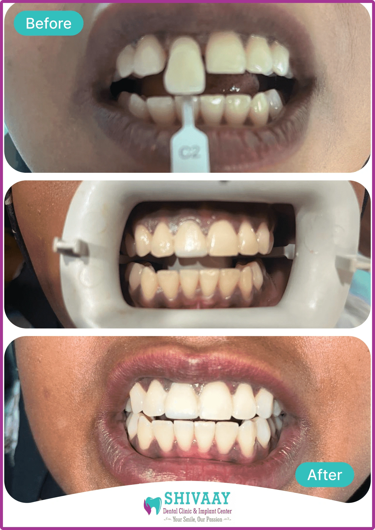 Teeth whitening 1