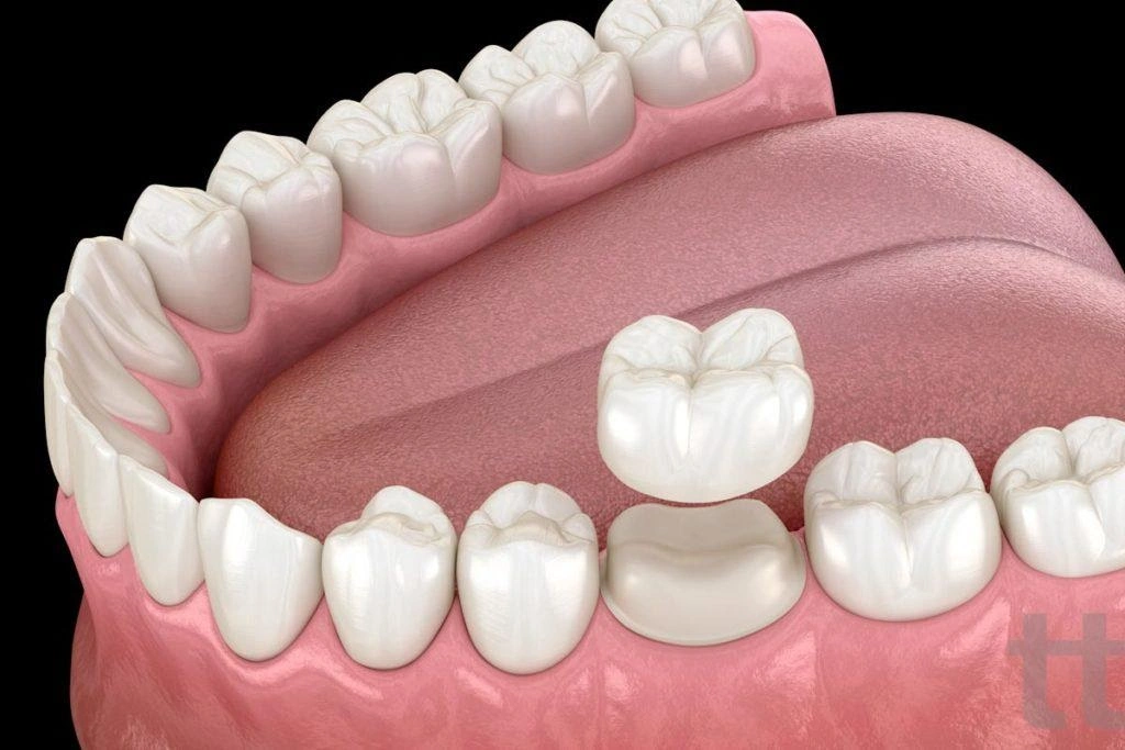 crown and bridges images