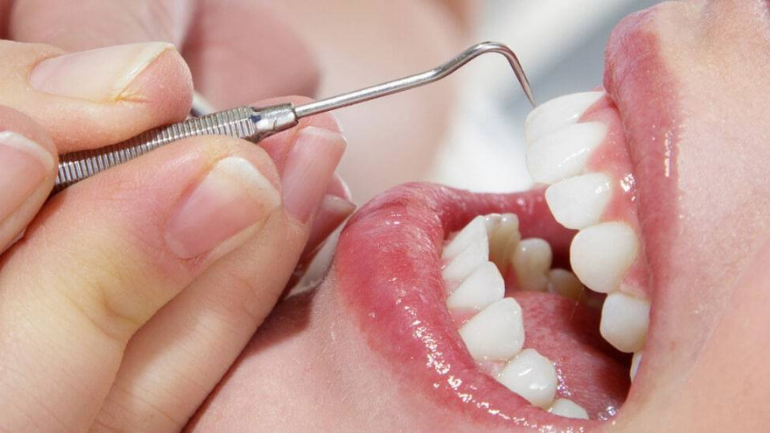 How Often Should You Really Get Your Teeth Cleaned? (Professional vs. DIY)