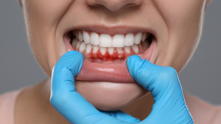 How to Prevent and Treat Gum Disease Before It’s Too Late